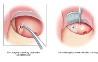 During the first stage of a two-stage procedure in which cholesteatoma and/or scarring has affected the stapes, placing a laser mark on the capitulum is a helpful guide to identification of the stapes during the second stage.
