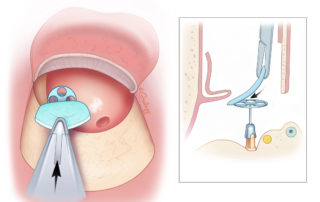 Placement of cartilage graft can displace the prosthesis.