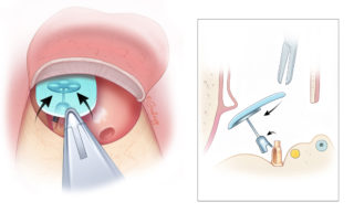 If the cartilage contacts the prosthesis prematurely, it rotates anteriorly.