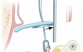 The shaft of a suction can be used to help stabilize the prosthesis during cartilage placement.