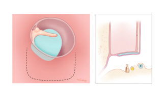 One advantage of staging the procedure is that cartilage placed at the first stage is already integrated with the tympanic membrane. It is important to have a tympanomeatal flap of adequate length as the flap shortens due to tenting of the drum by the prosthesis and an annular dehiscence may result if the flap is of insufficient length. Note that the tympanomeatal flap stops short of the annulus so that the tympanic membrane remains under tension to help support the prosthesis in position.