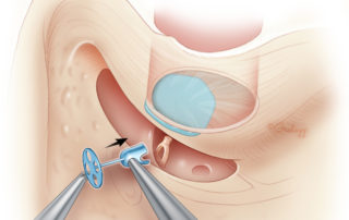 During a planned second-stage procedure in which the facial recess had been opened during the first stage, it is possible to insert an ossicular prosthesis through the mastoid via the facial recess.
