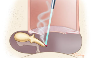 Laser resection of the distal segment of the umbo enables placement of the graft without need for interrupting the ossicular chain. The laser chars bone rather than vaporizing it, necessitating sequentially picking away the char while the bone thins. Placing moist-absorbable gelatin sponge beneath the umbo lessens the injury to the promontory mucosa due to overshoot.
