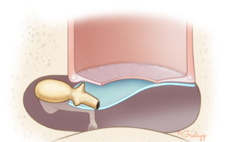 Placement of the graft medial to the umbo remnant.