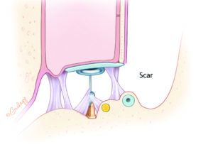 Ossiculoplasty performed in a single stage with poor middle ear mucosa may result in scarring with either displacement or impaired vibration of the prosthesis.
