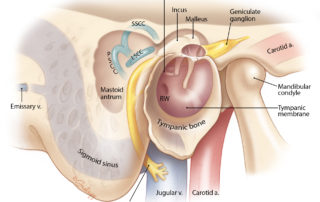 Anatomical relationships of the mastoid antrum and air cells: lateral view. LSCC, lateral semicircular canal; PSCC, posterior semicircular canal; SSCC, superior semicircular canal.