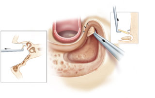 Flaking off the last thin sheet of bone over the incus and malleus with a stapes knife or curette protects the ossicles from contact with the drill which could cause cochlear injury.