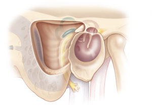Intact canal wall mastoidectomy bounded superiorly by the tegmen, posteriorly by the sigmoid sinus, and anteriorly by the ear canal.