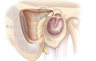 Intact canal wall mastoidectomy bounded superiorly by the tegmen, posteriorly by the sigmoid sinus, and anteriorly by the ear canal.