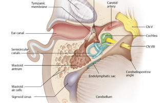 Anatomical relationships of the mastoid antrum and air cells: axial view. CN V, trigeminal nerve; CN VII, facial nerve.