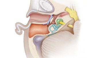 Intact canal wall mastoidectomy connecting to the middle ear via the aditus-ad-antrum.