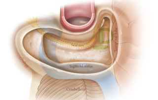 Mastoidectomy and its relationships. Note the temporal lobe above the tegmen and cerebellum behind the sigmoid sinus. The second genu, vertical segment, and stylomastoid foramen of the facial nerve are situated in the floor of the mastoid as are the three semicircular canals.