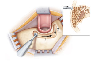 Initial removal of the mastoid cortex behind and above the ear canal is conducted with a cutting burr.