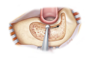 Thinning of the bony ear canal by removing air cells.