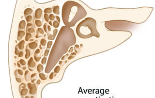 While the mastoid antrum is consistent, much variation exists in the pattern and extent of the peripheral air cell system. This is the average degree of pneumatization.