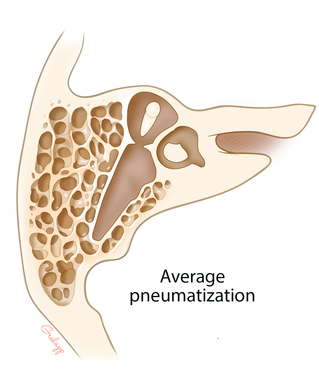 Mastoidectomy Types