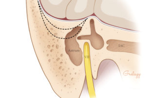 Variation of the tegmen mastoideum from normal to low position. VII, facial nerve; IAC, internal auditory canal.