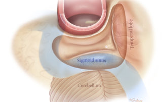 Poorly pneumatized mastoid with low temporal dura and forward sigmoid sinus. This constrains the size of the mastoid cavity.