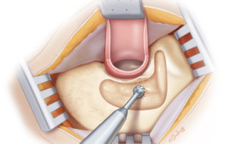Mastoidectomy in a hypopneumatic mastoid. Note that the tegmen may be so low as to preclude the superior extension above the ear canal.