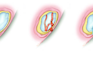 If bleeding occurs from exposed dura, it is best to control with an absorbable gelatin sponge – adrenalin pledget and avoid electrocautery which might disrupt the dura. Cerebrospinal fluid leakage necessitates repair. This can be achieved from below if minor and easily controlled or from above (extradural middle fossa craniotomy) if the injury is large or leakage is difficult to control from below.