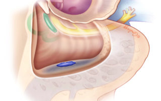 Exposure of the sigmoid sinus during mastoid surgery is common.