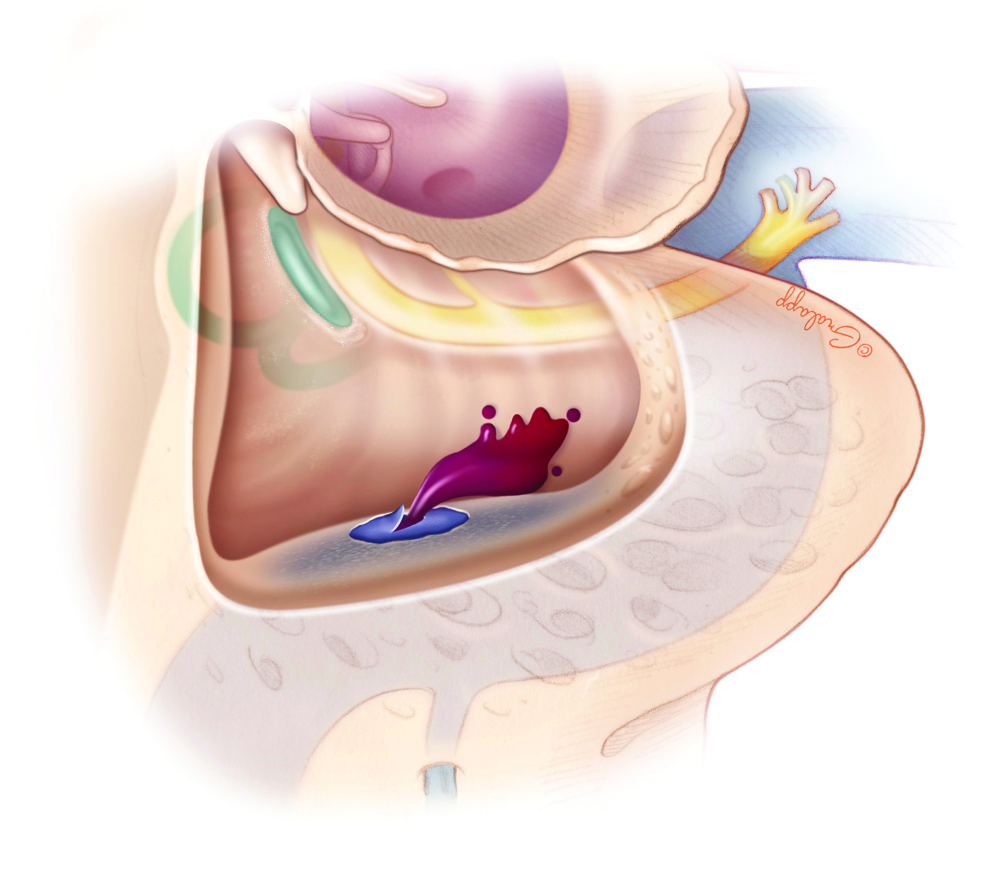 complications-of-mastoidectomy-oto-surgery-atlas