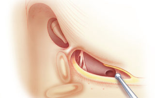 Inferior extension of the facial recess approach, as used in cochlear implantation, to expose the round window.