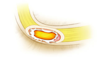 A drill injury which disrupts the epineurium, but leaves the nerve fibers intact.