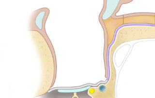 Canal wall down mastoidectomy creates a cavity of varying size depending on the size of the mastoid. A large cavity can accumulate debris and is more likely to discharge.