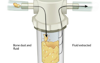 Bone dust is gathered using a collector placed in line with the suction (e.g., Sheehy Bone Duct Collector). A wire-mesh sieve collects particulate matter while allowing irrigant to pass through. Some surgeons mix the harvest bone paté with the patient’s blood.