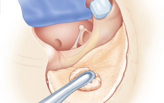 The fascia graft (blue) and tympanomeatal flap are retracted anteriorly. The epitympanum may be obliterated with cartilage (as shown here) or bone dust.