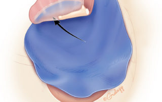 A large temporalis fascia graft both reconstructs any tympanic membrane defect and covers the bone paté.