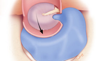 The tympanomeatal flap is laid back down into anatomical position, allowing the underlying fascia graft to cover the exposed bone dust.