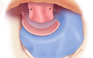 The lateral ear canal skin (Koerner’s flap) is then placed back into position and secured posteriorly using two absorbable sutures (indicated by black dots).
