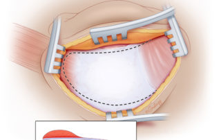 Superiorly based mastoid obliteration flap may be created with only periosteum and fascia only or may incorporate muscle.