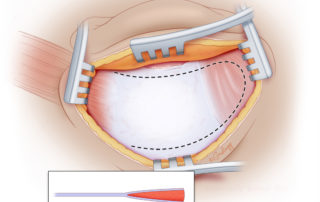 Inferiorly based mastoid obliteration flap may be created with only periosteum and fascia only or may incorporate muscle.