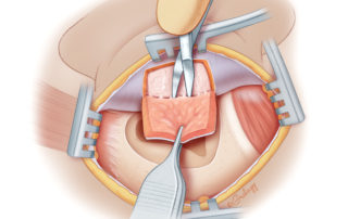 Creation of a meatally based mastoid obliteration flap (also known as a Palva flap).