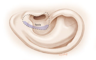 In a small cavity, a fascia or periosteal flap may be sufficient.