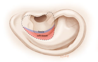 In a larger cavity, fascia and muscle flap provide additional bulk.