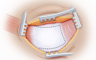 An inferiorly based periosteal flap is fashioned in preparation for mastoid obliteration with autologous bone dust.