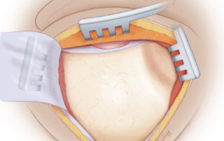 Periosteal flap is reflected inferiorly and the temporalis muscle retracted superiorly.