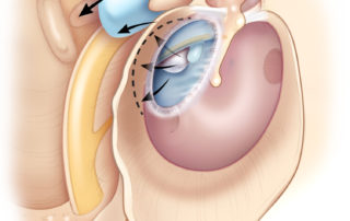 Posterior mesotympanic cholesteatoma illustrating the pathways to the mastoid and middle ear. Note that the penetration to the mastoid is medial to the ossicles. Posterior mesotympanic cholesteatoma tends to involve the posterior tympanic spaces: the sinus tympani and facial recess (see section 8.8 Sinus Tympani and Facial Recess in Cholesteatoma). (Used with permission from Jackler RK. The surgical anatomy of cholesteatoma. Otolaryngol Clin NA 1989;22:883–896.)
