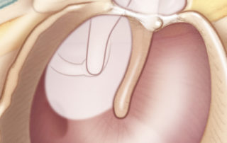 Primary acquired cholesteatoma arises from the epitympanum, posterior mesotympanum, or both, but almost never from the anterior or inferior aspects of the tympanic membrane. This means that primary acquired cholesteatomas almost universally are intimately involved with the ossicles.