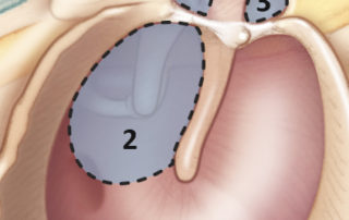 The origin of cholesteatoma is from the posterior epitympanum (1) most commonly, followed by posterior mesotympanum (2), and then anterior epitympanum (3). Sometimes pockets occur in combinations such as posterior epitympanic with posterior mesotympanic or both posterior and anterior epitympanic together.