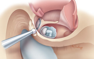 Beginning removal of the posterior ear canal wall.
