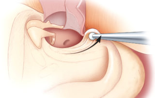 Lowering facial ridge does not require exposure of the facial nerve. It is best to leave 2 to 3 mm of bone over the nerve to maintain a middle ear space.