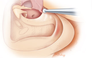Lowering the floor of the middle ear to the level of the facial ridge (base of the ear canal).