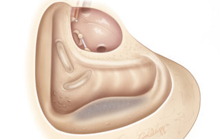 Osseous anatomy of a completed canal wall down mastoidectomy. In modern times, middle ear reconstruction is almost always performed creating a modified radial mastoidectomy. A true radial mastoidectomy, leaving the middle ear open, is seldom used today but may be necessary when the cholesteatoma adheres tenaciously to the tympanic section of the facial nerve and/or stapes footplate, especially when matrix prolapses into the mouth of the Eustachian tube.
