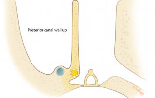 Intact canal wall mastoidectomy.