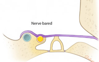 Baring the facial nerve places it at risk raising a flap off the floor of the cavity during subsequent revision surgeries for ossiculoplasty.